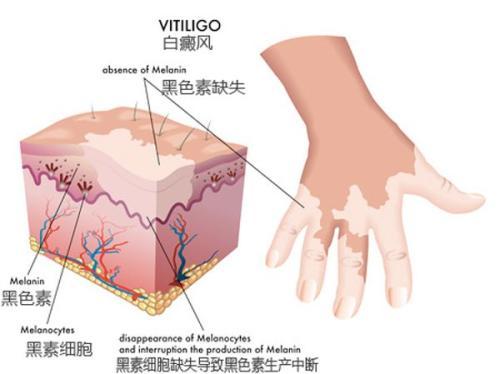 三个月宝宝身上有白斑，原因、诊断与治疗方案